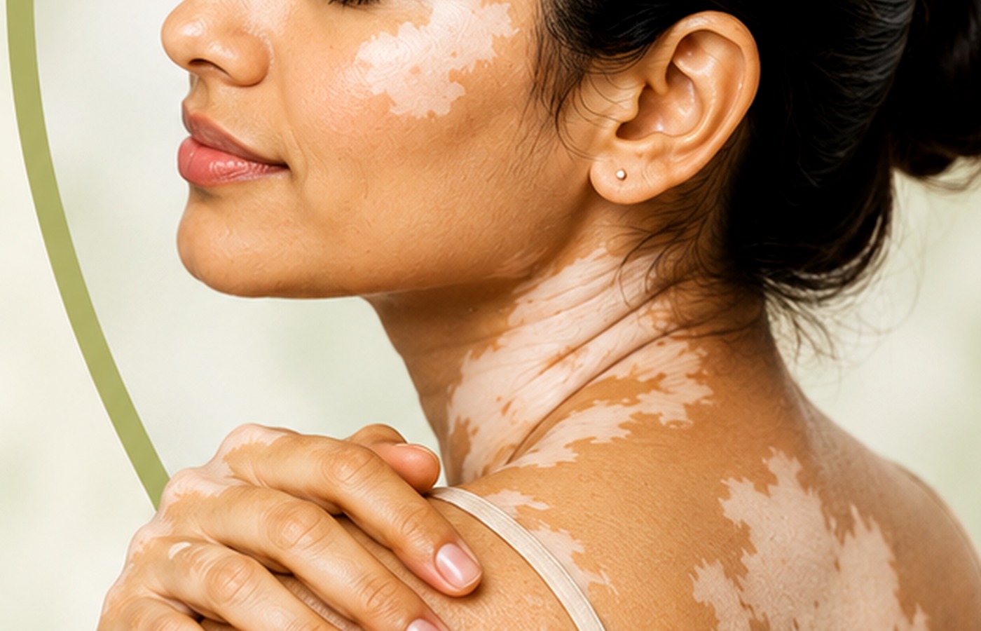 Vitiligo